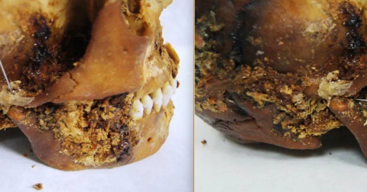 O femeie scită supusă unei intervenții chirurgicale complexe acum 2.500 de ani O descoperire arheologică uimitoare dezvăluie faptul că o femeie scită din Siberia, care a trăit acum aproximativ 2.500 de ani, a supraviețuit unei intervenții chirurgicale complexe la maxilar