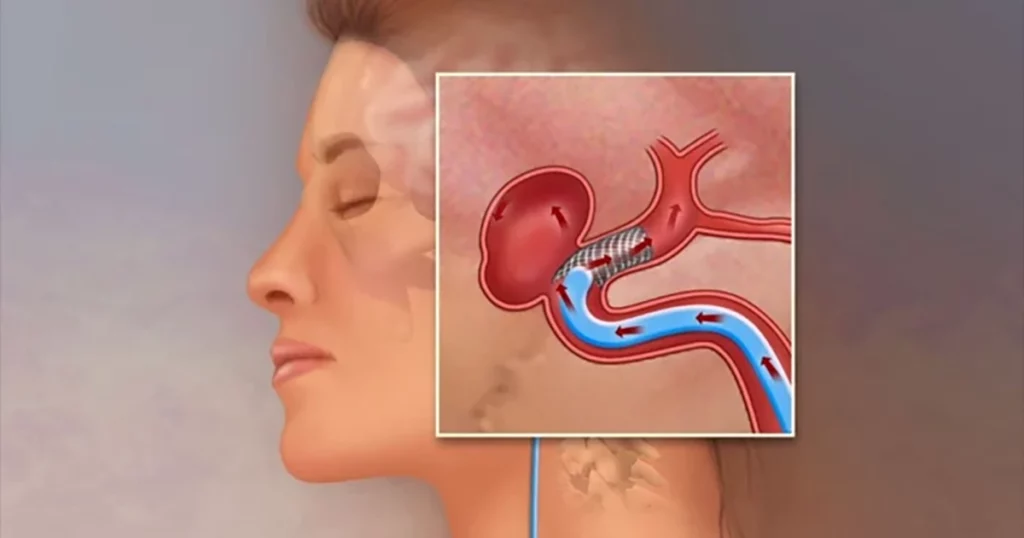 Atenție la semnalele creierului: Două simptome care pot indica un anevrism cerebral Un medic neurolog avertizează asupra a două simptome care nu trebuie ignorate, deoarece pot sugera prezența unui anevrism cerebral, o afecțiune potențial fatală
