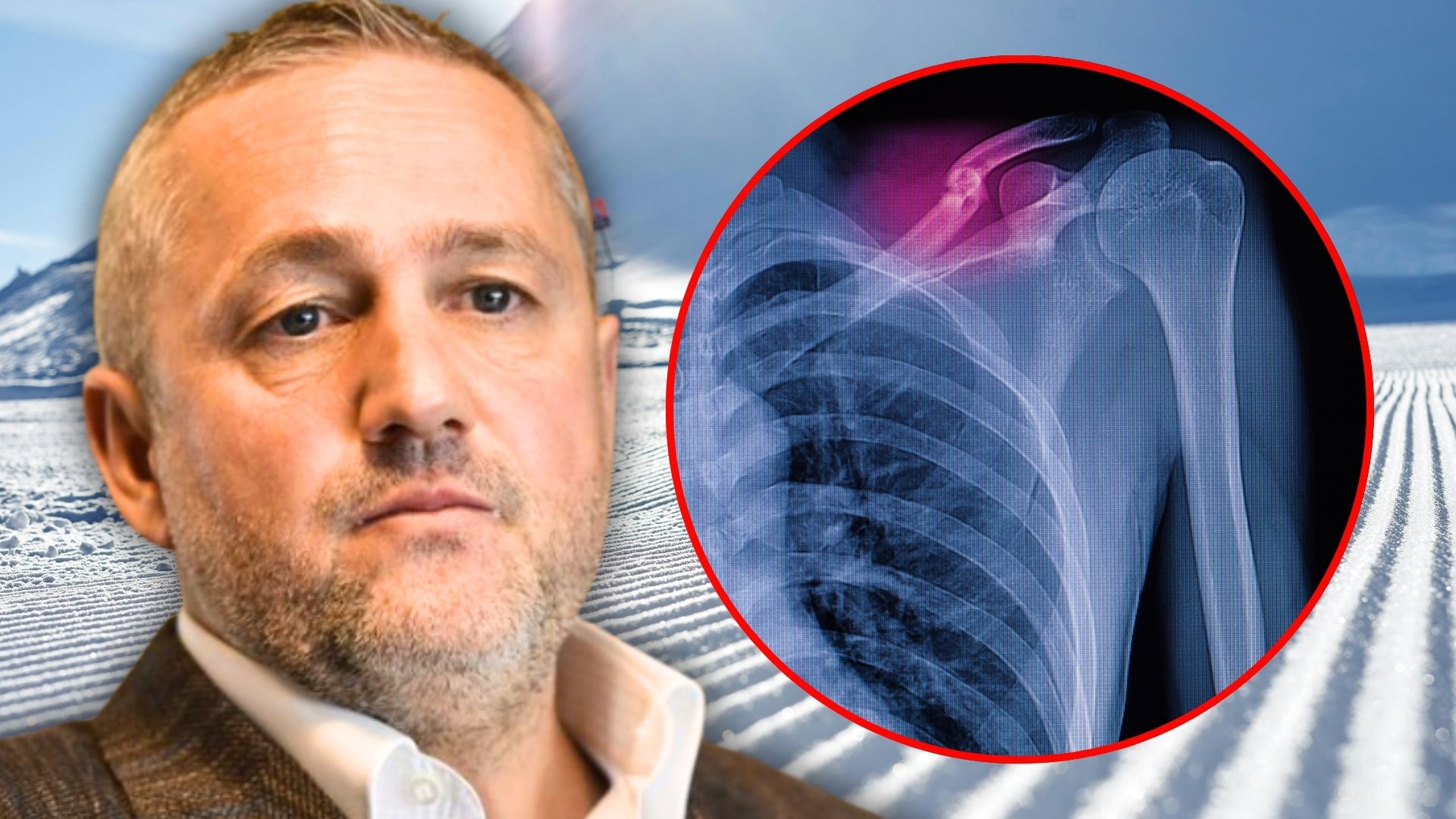 Mihai Rotaru, după accidentul la schi: „Am 8-10 șuruburi în corp!”