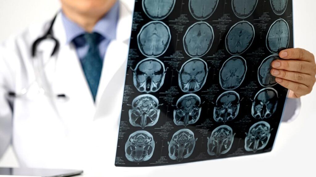 Colesterolul „rău” nu spune totul: un nou indicator ar putea prezice mai bine riscul de AVC Monitorizarea regulată a colesterolului este un obicei sănătos, dar medicii avertizează că, singură, nu este suficientă pentru a evalua riscul de accident vascular cerebral (AVC)