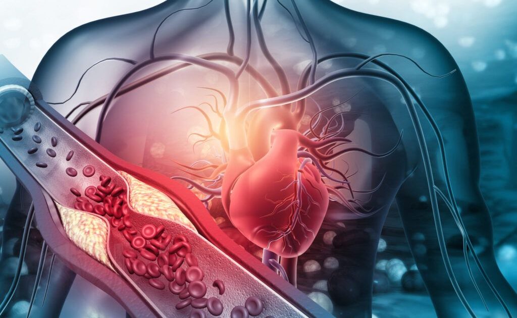 Atenție, infarct! Alimentul-minune dezvăluit de un medic pentru artere curate