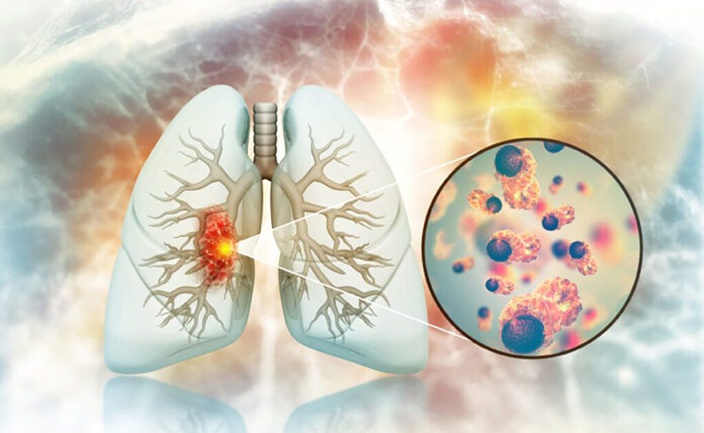 Cancerul pulmonar la nefumători: Legătură ȘOCANTĂ cu legume și fructe