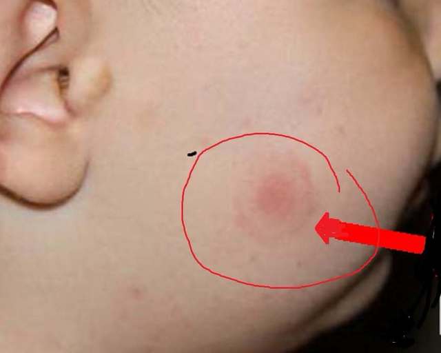 Ciuhodaru, avertisment crucial: Sezonul căpușelor bate la ușă