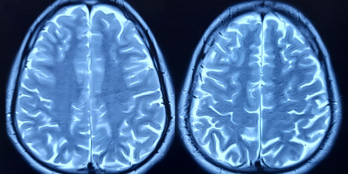 Oamenii de știință au dat verdictul: Ce grăbește îmbătrânirea creierului