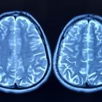 Oamenii de știință au dat verdictul: Ce grăbește îmbătrânirea creierului
