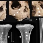 Dinții copiilor antici: Boala mortală care bântuia acum 4000 de ani