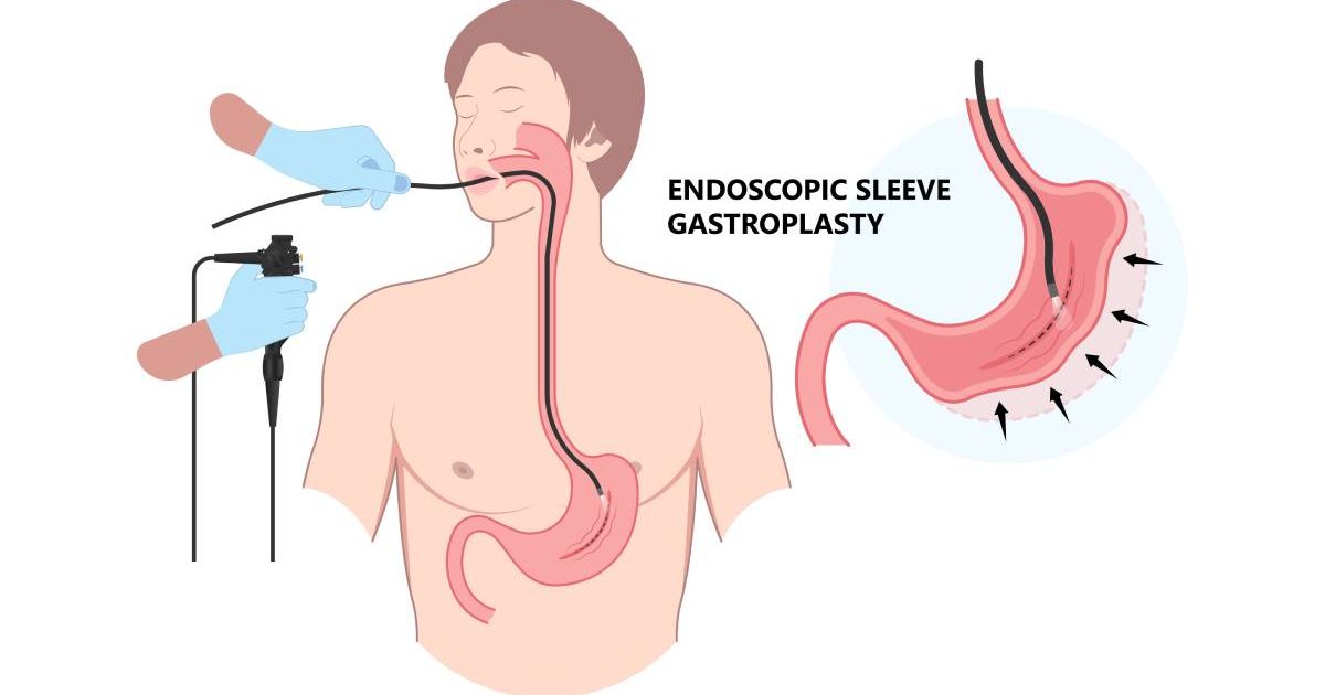 Nouă metodă de slăbire: Endoscopia, alternativa non-invazivă la operație