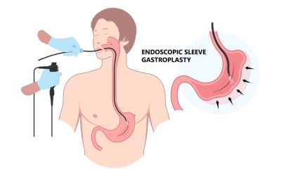 Nouă metodă de slăbire: Endoscopia, alternativa non-invazivă la operație