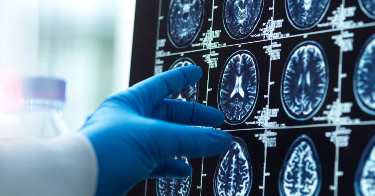 O nouă hartă detaliată a îmbătrânirii creierului dezvăluie vulnerabilități genetice și legături cu Alzheimer Un studiu recent, publicat în revista GeroScience, a creat prima hartă detaliată a îmbătrânirii creierului, oferind noi perspective asupra modului în care factorii genetici influențează acest proces