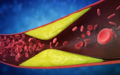 Șapte semne de artere blocate ignorate de mulți: Avertismentul cardiologilor