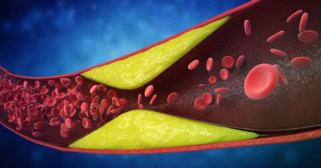 Șapte semne de artere blocate ignorate de mulți: Avertismentul cardiologilor