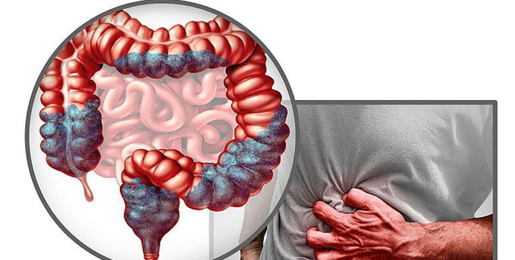 Aproape jumătate dintre adulți ignoră legătura dintre consumul de alimente procesate și riscul de cancer colorectal, conform datelor recente