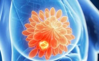 Factori cruciali în vindecarea după cancerul de sân, potrivit specialiștilor