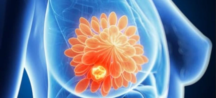 Factori cruciali în vindecarea după cancerul de sân, potrivit specialiștilor