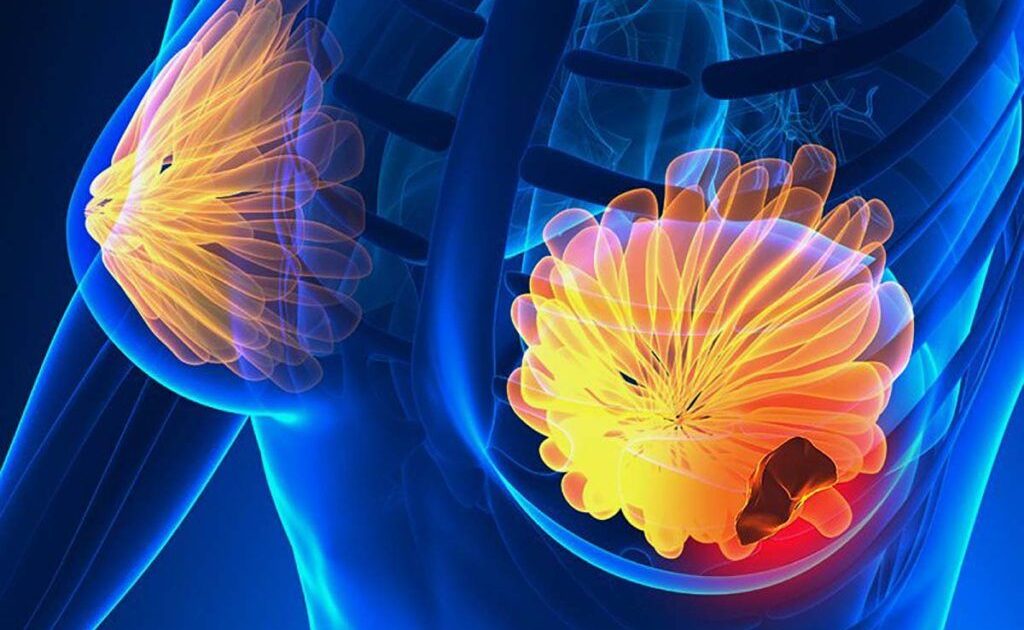 Semnele cancerului de sân: 5 simptome la care trebuie să fii atentă