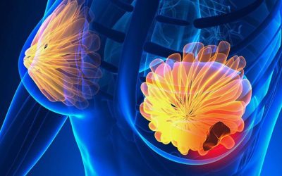 Semnele cancerului de sân: 5 simptome la care trebuie să fii atentă