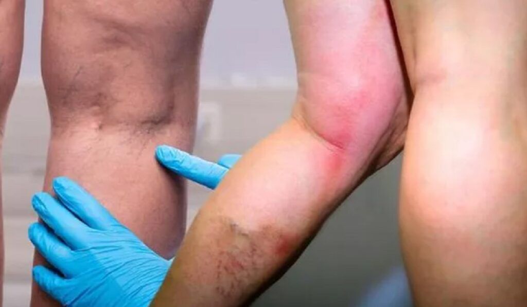 Vitamina-minune: Previne cheagurile și întărește imunitatea!