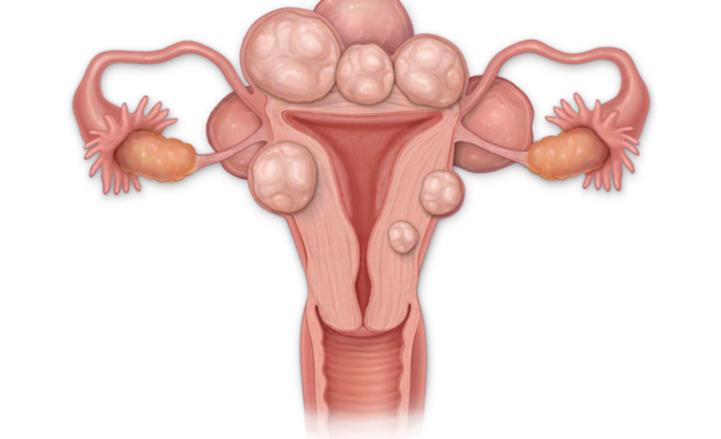 Fibromul uterin: De ce apar, cum se manifestă și ce opțiuni de tratament există Fibromul uterin, o afecțiune ginecologică frecvent întâlnită la femei, reprezintă o preocupare pentru multe dintre ele