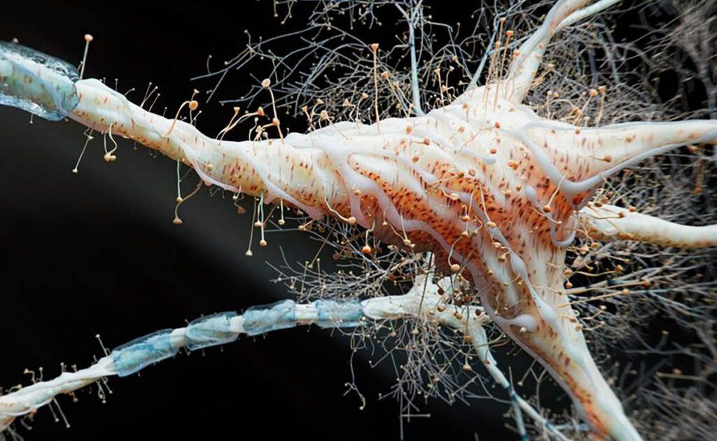 Inflamația intestinală, posibil factor cheie în scleroza multiplă