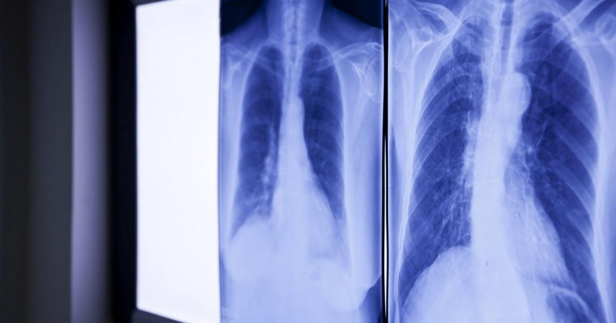 Medicii, șocați de ce au găsit în abdomen: Obiectul era acolo de peste 20 de ani