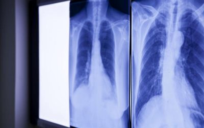 Medicii, șocați de ce au găsit în abdomen: Obiectul era acolo de peste 20 de ani