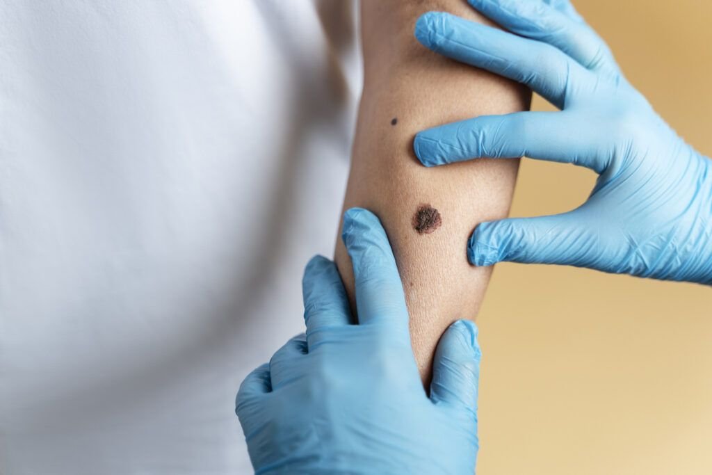 O femeie din Anglia, mamă a doi copii, a murit la 37 de ani după ce un cancer de piele, depistat prea târziu, a evoluat rapid