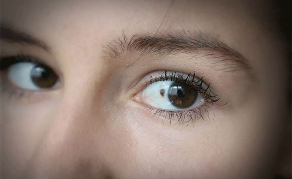 Semnalele cancerului ocular: 11 indicii subtile pe care le poți ignora