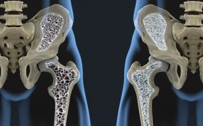 Nou tratament revoluționar: Oase mai puternice și densitate refăcută, inclusiv în osteoporoză