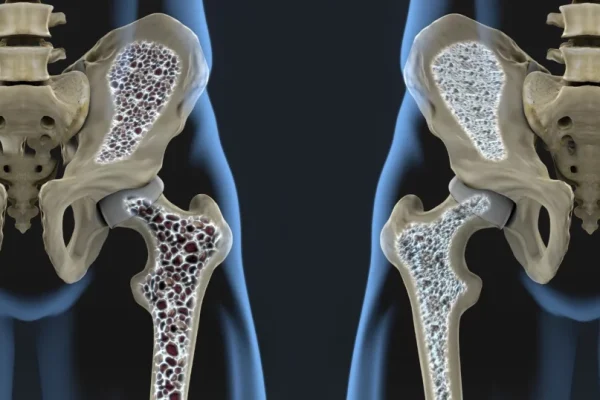 Nou tratament revoluționar: Oase mai puternice și densitate refăcută, inclusiv în osteoporoză