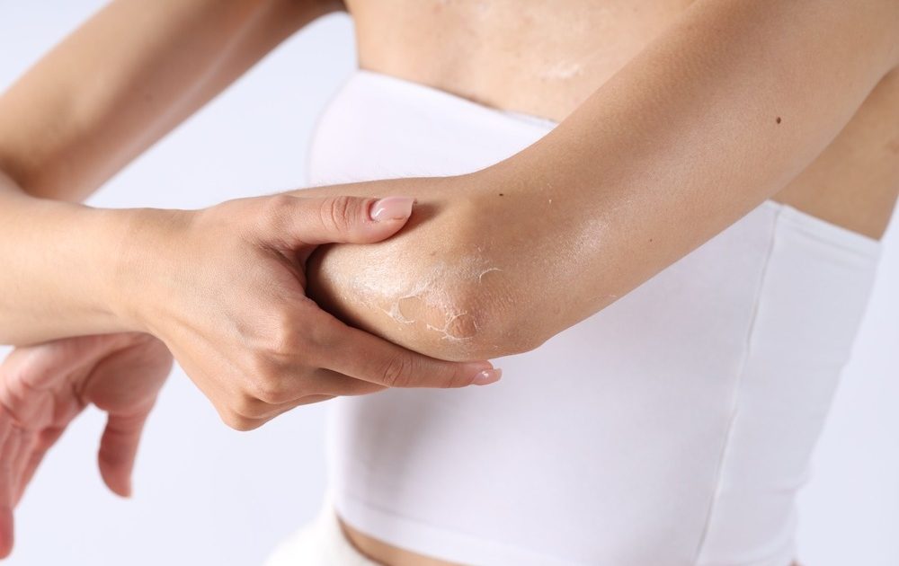 Piele uscată pe brațe și picioare? 5 obiceiuri care usucă pielea