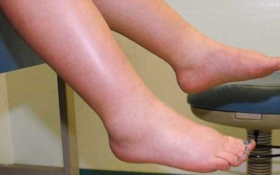 Leguma-minune: Scapă de retenția de apă și stimulează circulația!