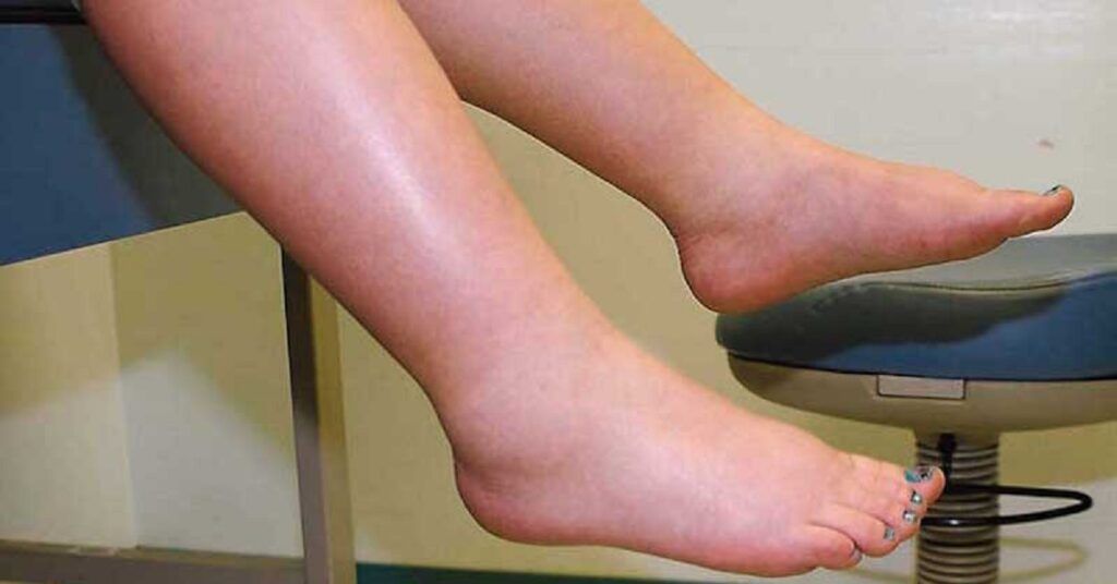 Leguma-minune: Scapă de retenția de apă și stimulează circulația!