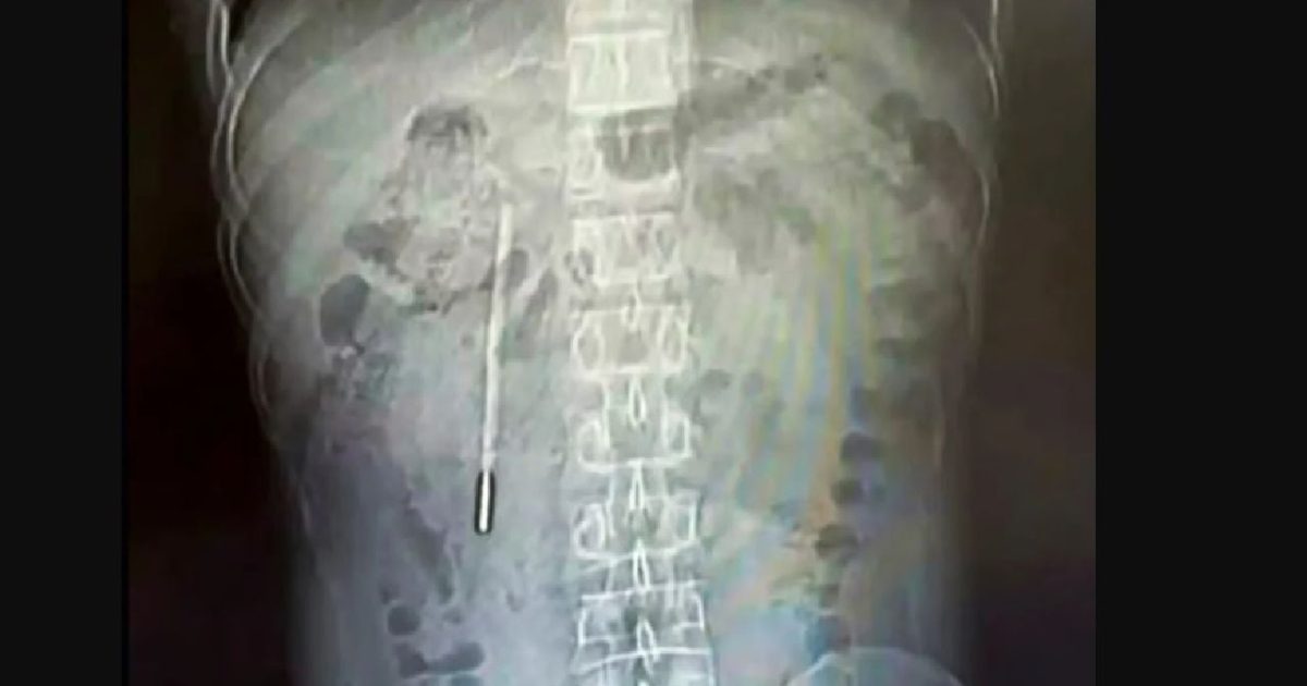 Termometru înghițit de un copil chinez, scos intact din stomac