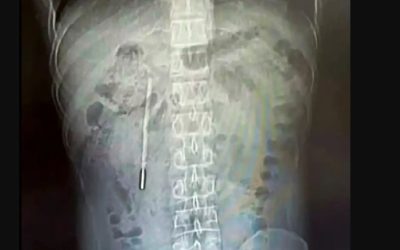 Termometru înghițit de un copil chinez, scos intact din stomac