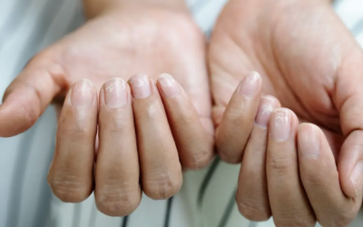 Uite semnul discret de pe unghii! Ce boli grave pot ascunde „unghiile Terry”