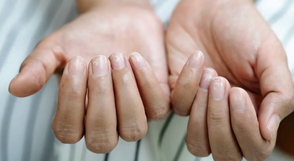 Uite semnul discret de pe unghii! Ce boli grave pot ascunde „unghiile Terry”