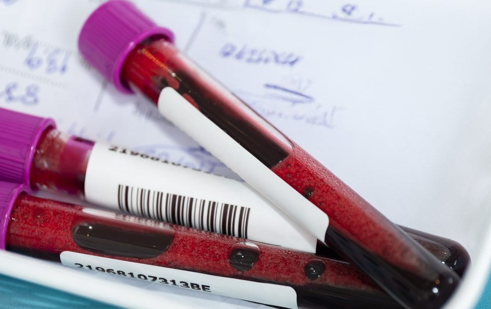 Ce analize arată dacă diabetul a distrus rinichii: Teste vitale pentru sănătate