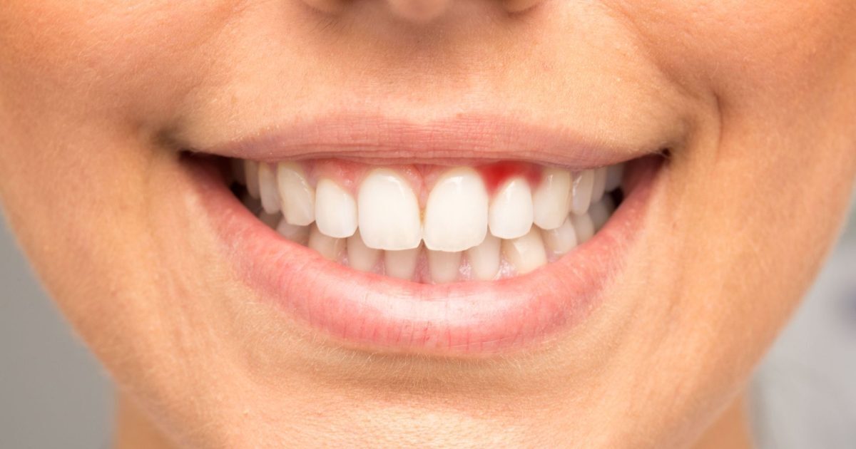 Gingii sângerânde? Avertisment serios pentru sănătatea ta