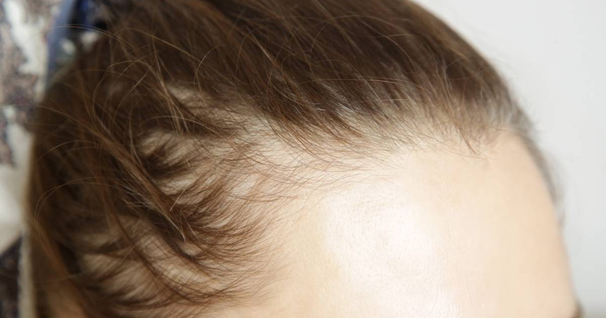 Injecții de slăbit cauzează căderea părului? Află legătura cu alopecia