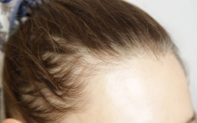 Injecții de slăbit cauzează căderea părului? Află legătura cu alopecia