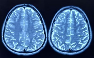 Depresia taie din creierul ce naște neuroni