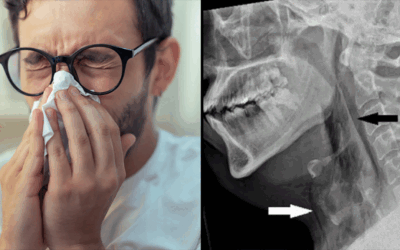 Strănutul oprit i-a rupt traheea unui bărbat. Medicii, șocați