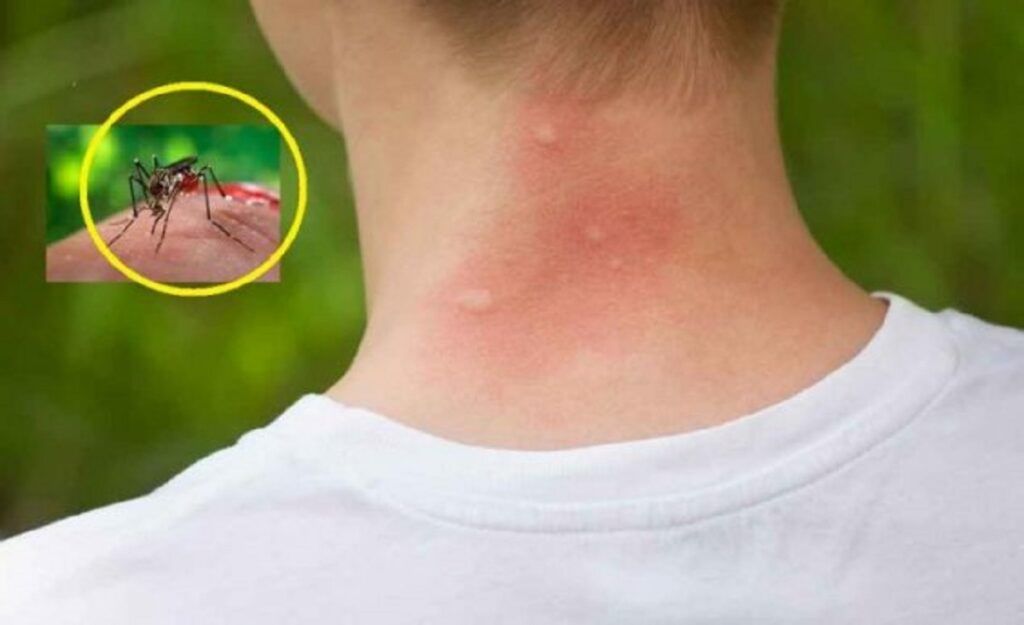 Țânțarii te preferă: 3 bacterii care explică mușcăturile