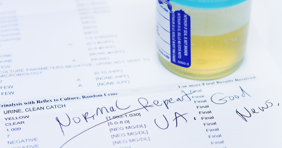 Test urină: Depistează 90% din cancerul de vezică